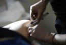 Mais 12 mil unidades do Implanon chegam às UBSs e ampliam oferta no DF