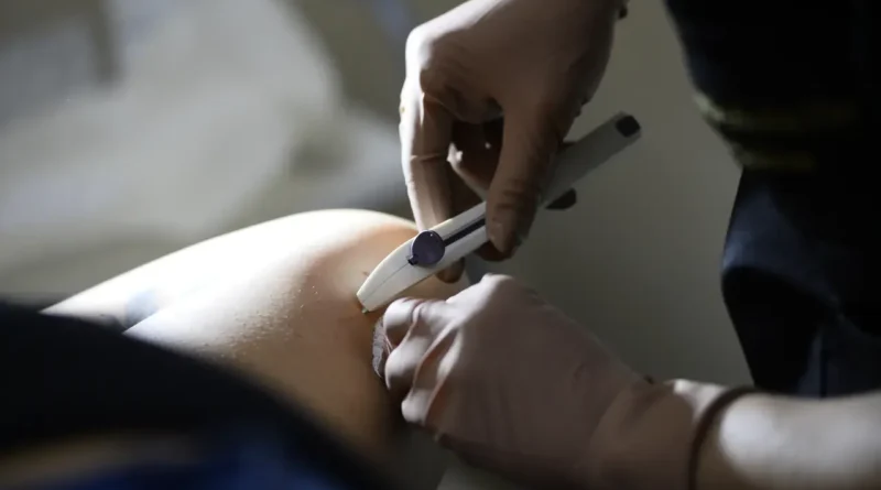 Mais 12 mil unidades do Implanon chegam às UBSs e ampliam oferta no DF
