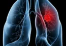 Saiba o que é adenocarcinoma pulmonar, câncer que atinge o papa