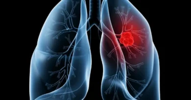 Saiba o que é adenocarcinoma pulmonar, câncer que atinge o papa