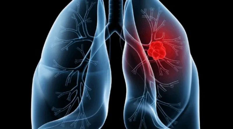 Saiba o que é adenocarcinoma pulmonar, câncer que atinge o papa